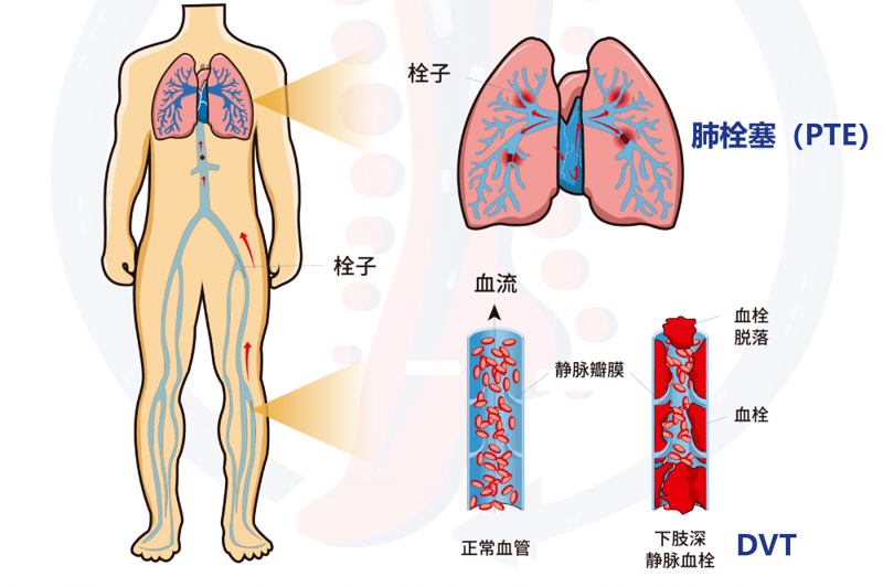 房颤患者如何科学抗凝？——经验分享