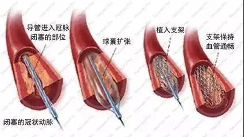 血栓预防门诊：如何避免“隐形杀手”的威胁